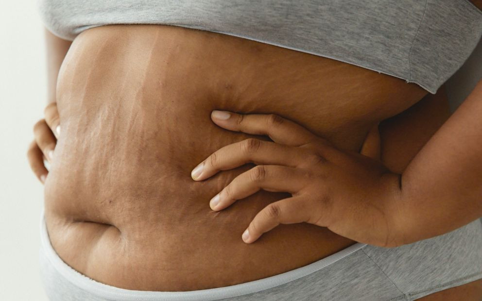 Vergetures ventre : les prévenir et les traiter