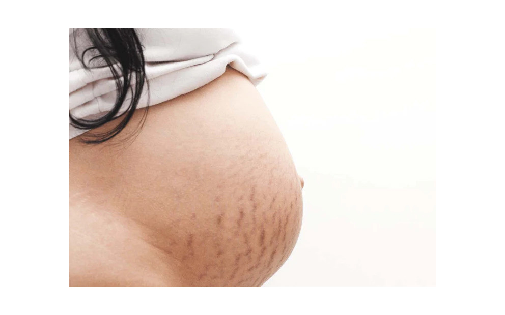 Vergetures grossesse : comment y remédier ?